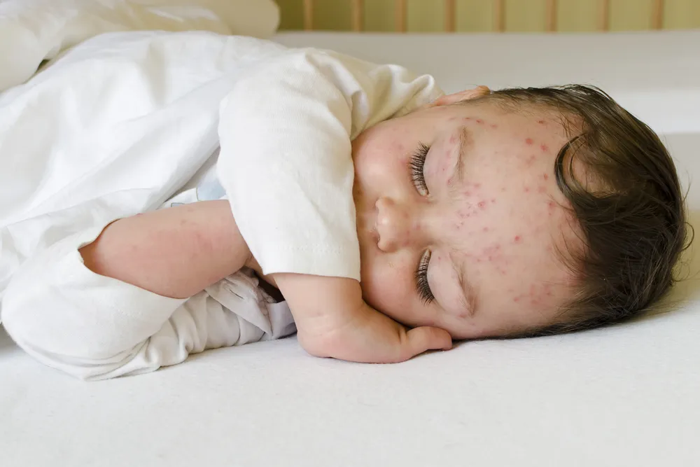 Important Signs & Symptoms Of Chicken Pox – ActiveBeat – Your Daily