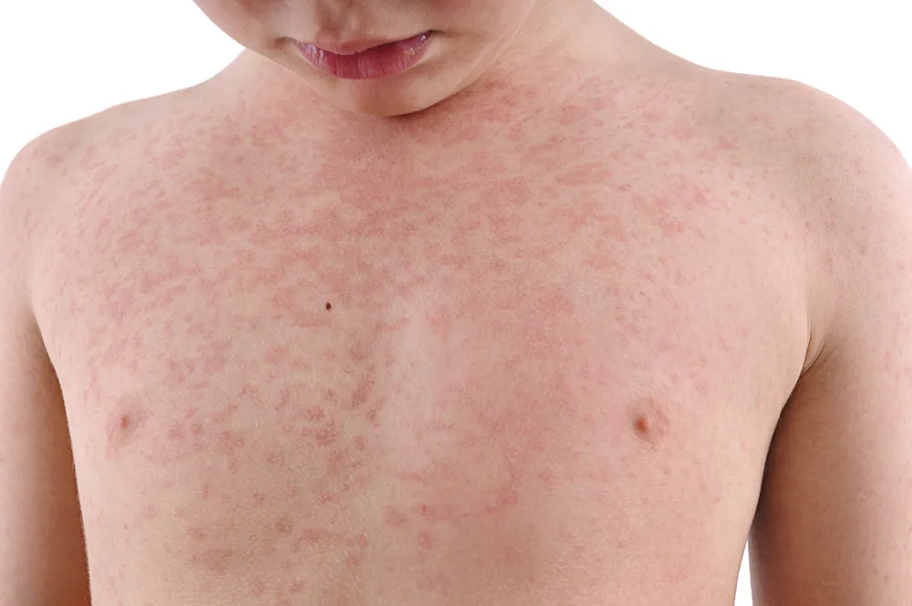 Common Causes of Rashes